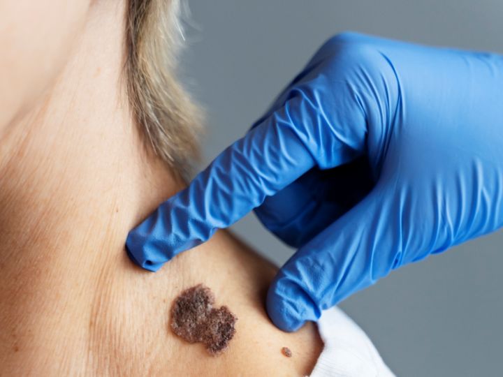 Melanoma