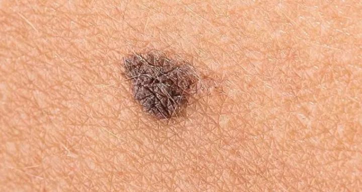 Melanoma